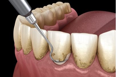 Ablazione del tartaro e levigatura radicolare albania dental aesthetic