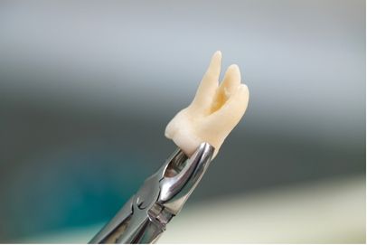 Rimozione dei denti del giudizio albania dental aesthetics