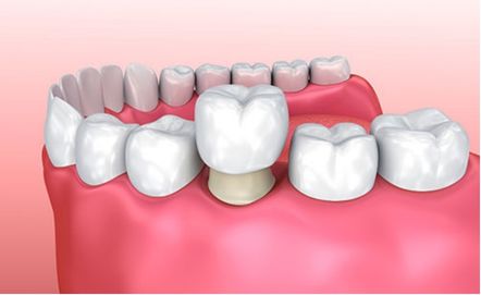 Trattamenti al fluoro albania dental aesthetic