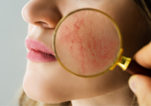 rosacea treatment