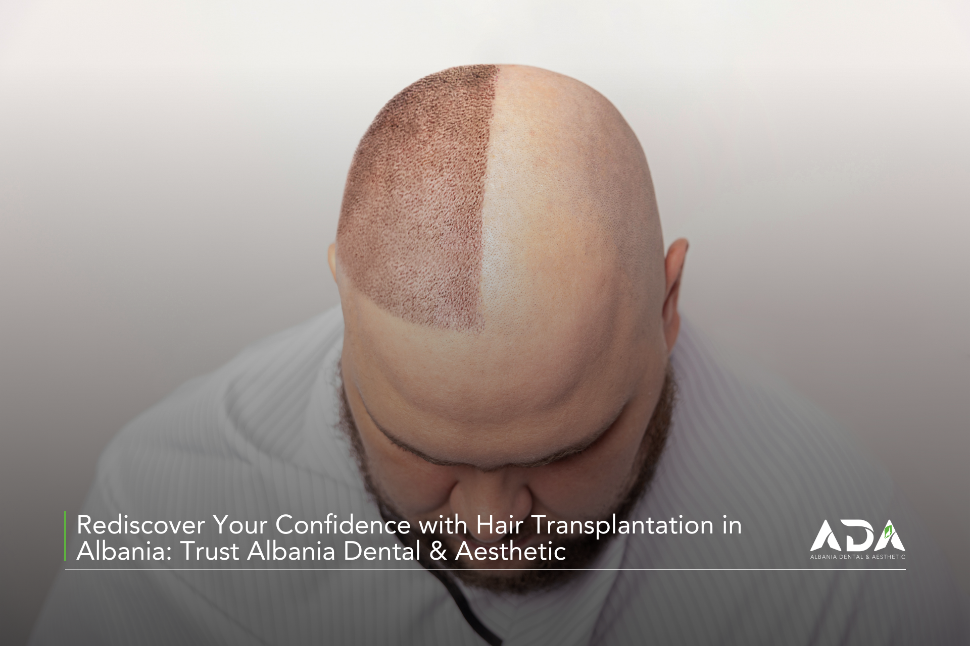 Rediscover Your Confidence with Hair Transplantation in Albania Trust Albania Dental & Aesthetic